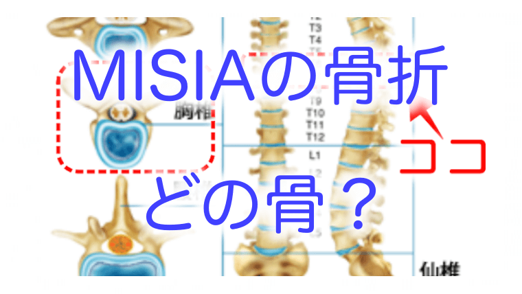 図解 Misiaが骨折した胸椎棘突起とは背骨のどこ 痛みやコルセットも調査 はぴたいむ